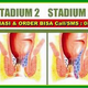 Illustration for article titled Cara mengobati wasir stadium 3 cepat sembuh